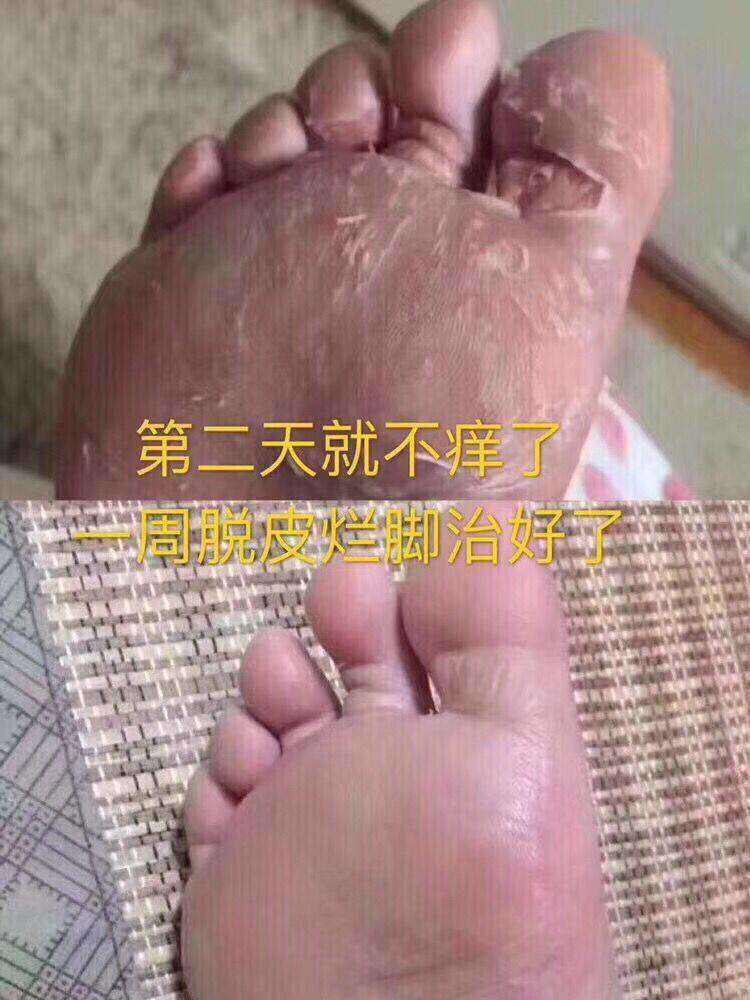 脚气痒痒难忍怎么办(孕晚期脚气痒痒难忍怎么办)