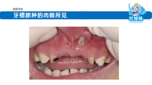 牙龈肿痛有脓包怎么办(牙龈肿痛有脓包吃什么药最好)