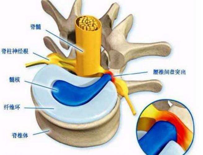 腰椎间盘突出怎么办(腰椎间盘突出腿麻妙招)