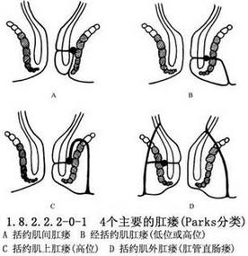 肛瘘怎么办(肛周脓肿引起肛瘘怎么办)