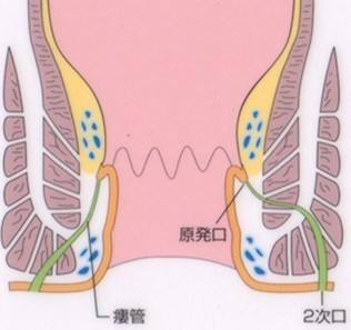 肛瘘怎么办(肛周脓肿引起肛瘘怎么办)