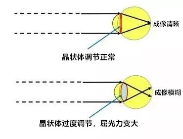 假性近视怎么办(9岁孩子假性近视怎么办)